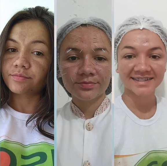 Resultados da terceira sessão de acupuntura Facial realizada pelo Dr Valdemir Paes, CRO: 1856-PI.